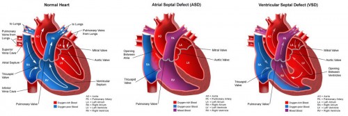 Congenital Heart Disease