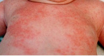 What Is Heat Rash in Kids?