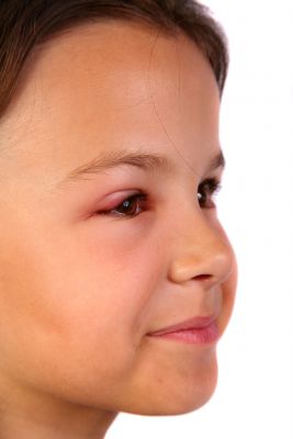 eye infection in children