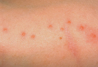 insect bite rash