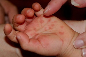 red rash on hand