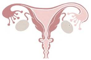 ovarian cancer