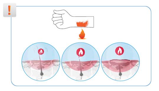 what happens to your skin when it is burned