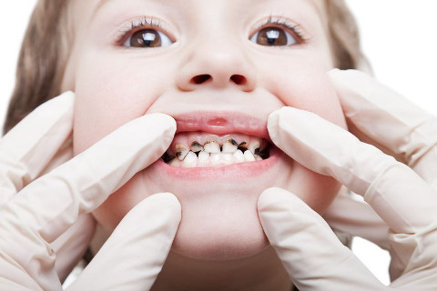 Tooth Decay in Children