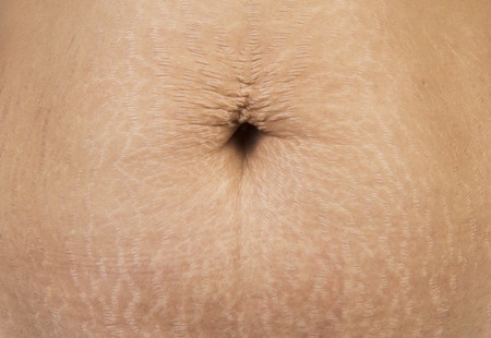 Debunking Common Myths About Stretch Marks