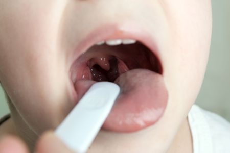 Sore throat in children
