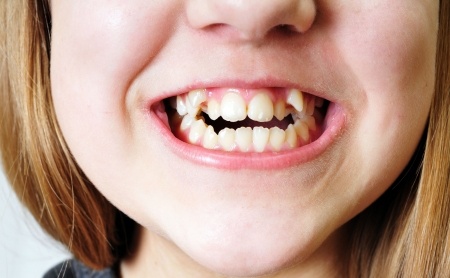 child with overcrowded teeth