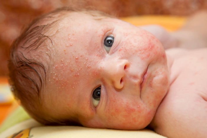 baby skin rash