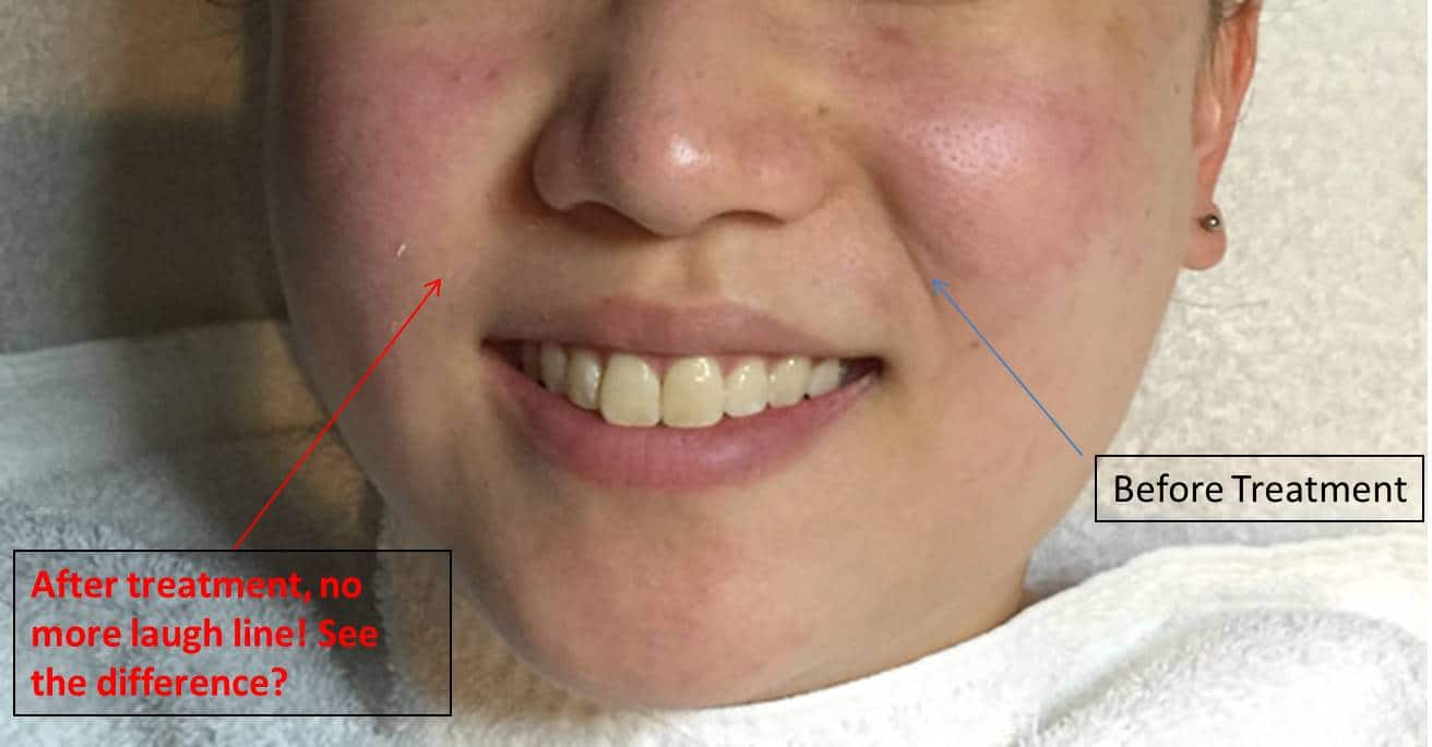 haach perfect v facial review contour massage result