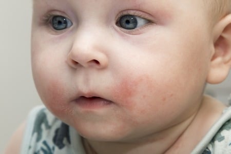 Skin Problems In Newborn Babies