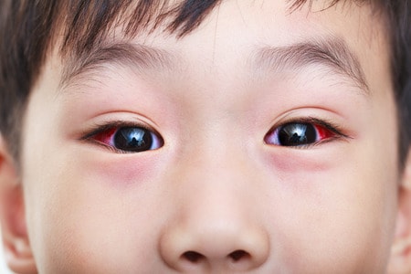 common childhood illnesses conjunctivitis