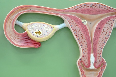 Polycystic Ovarian Syndrome PCOS