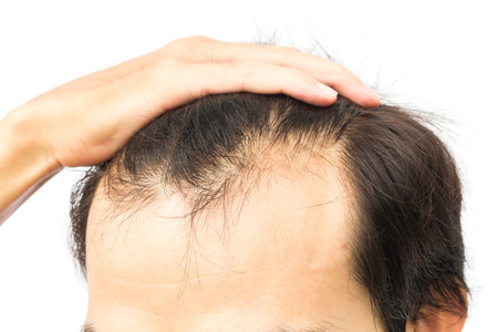  Is hair loss hereditary