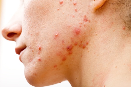 acne during pregnancy