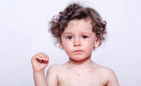 Common Rashes In Children And How To Manage Them