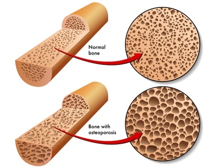 Osteoporosis bone