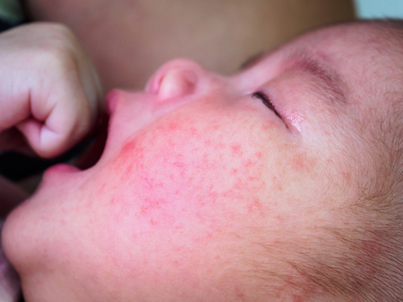 children skin rash dermatitis