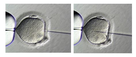 IntraCytoplasmic Sperm Injection (ICSI) Women and Men Fertility