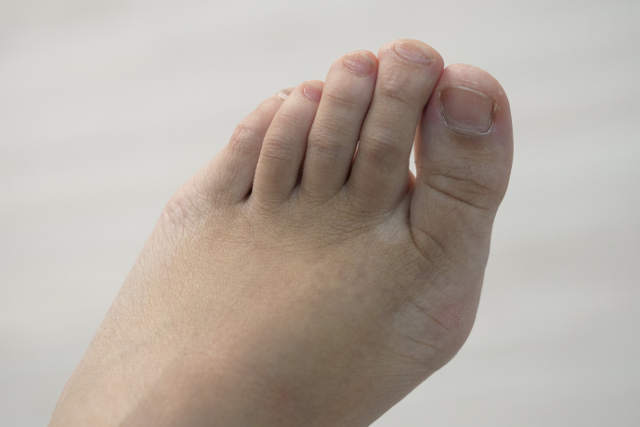 Juvenile Bunions