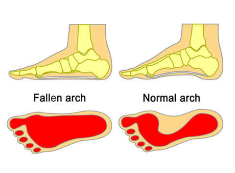 identify flat foot