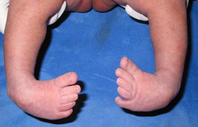 Clubfoot in babies and children