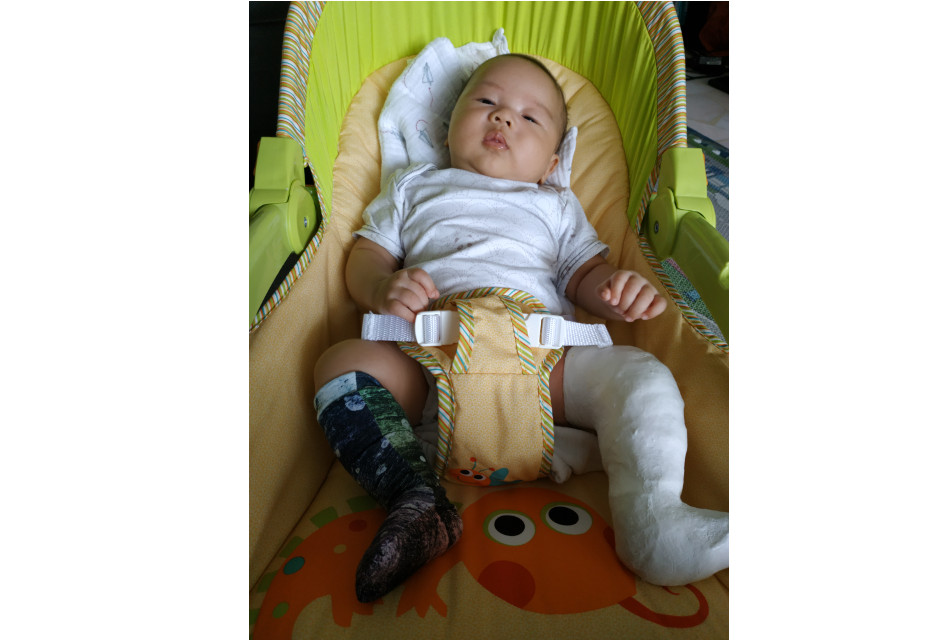 baby has clubfoot what to do