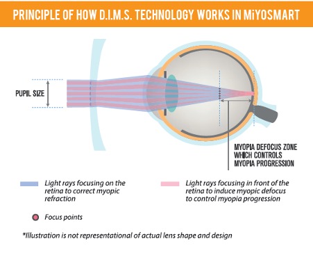 MiYOSMART Lens to control myopia