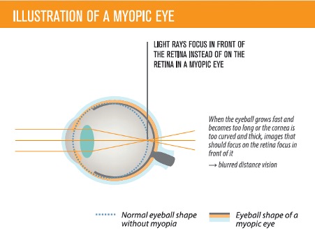 What is Myopia