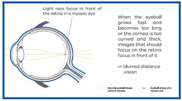 MiYOSMART Myopia Control HR