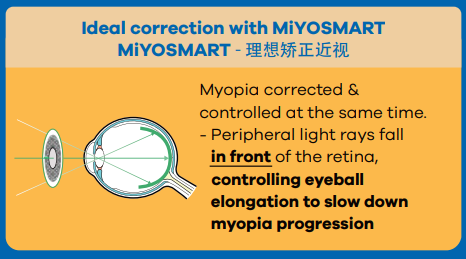 MiYOSMART Myopia ideal correction
