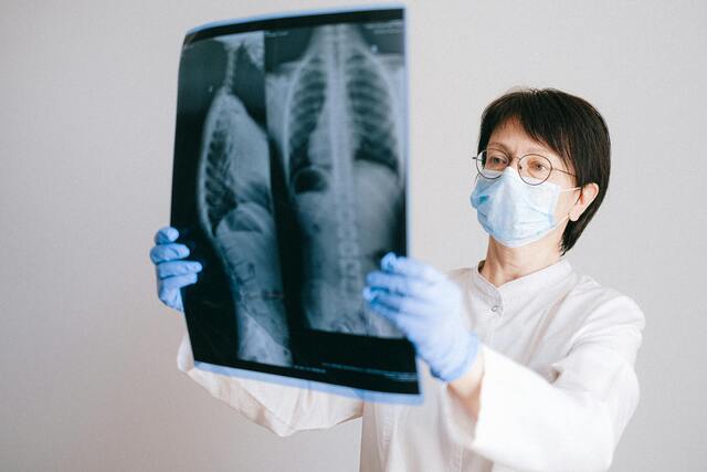 Scoliosis – Understanding the Silent Curve Affecting Singapore’s Adolescents